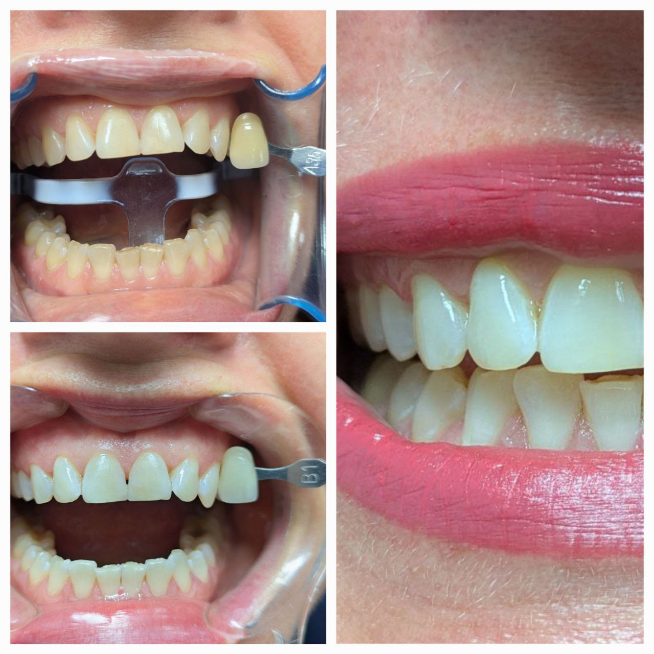 Wybielanie regenerujące Wrocław